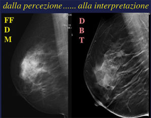 Mammografia 3d