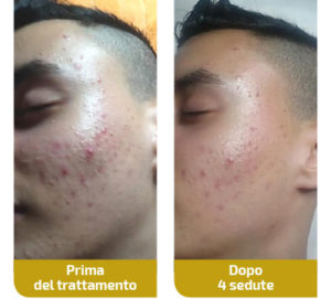 trattamento-acne