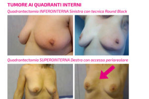 Tumori quadranti interni