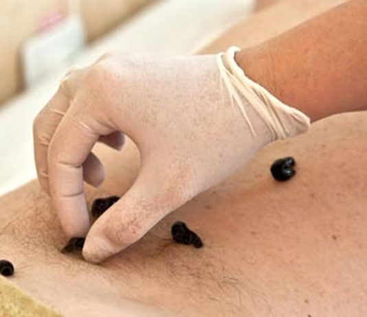 I rimedi di una volta sanguisuga