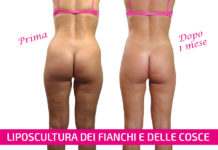 liposcultura