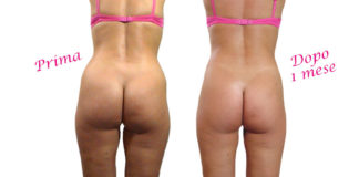 liposcultura