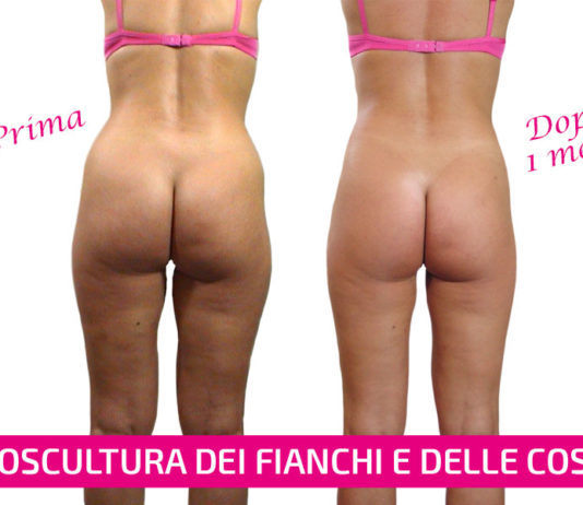 liposcultura