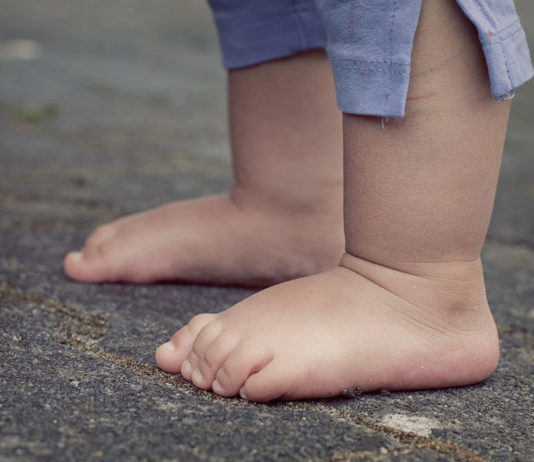 IL PIEDE PIATTO NEL BAMBINO piede piatto