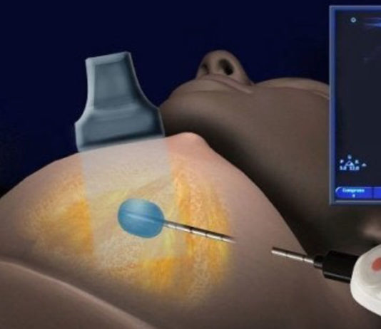 LESIONI MAMMARIE TRATTAMENTI NON CHIRURGICI LESIONI MAMMARIE