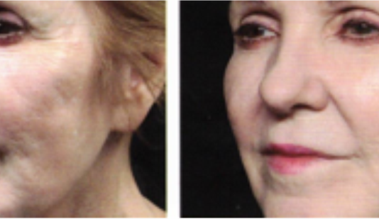 LA MEDICINA RIGENERATIVA IN ESTETICA IL P.R.P. (PLASMA RICCO DI PIASTRINE)