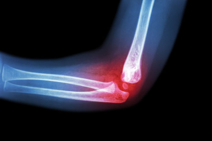 osteoporosi e prevenzione delle fratture
