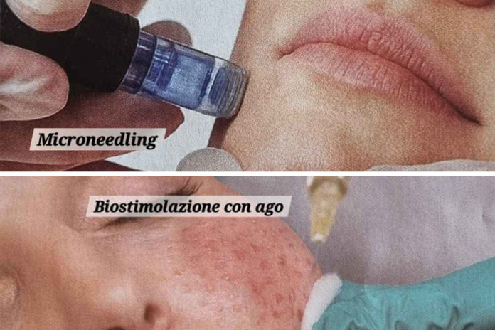 biostimolazione cutanea